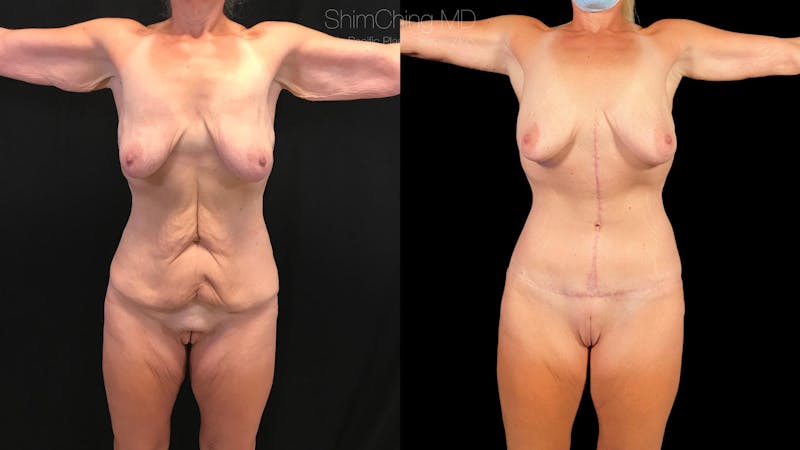 Before and after a Tummy Tuck in Hawaii with Dr. Shim Ching