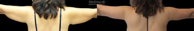 Arm Lift Before & After Gallery - Patient 38298973 - Image 1