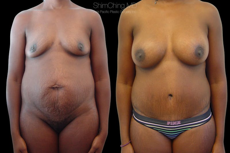 Before and after a Tummy Tuck in Honolulu with Dr. Shim Ching