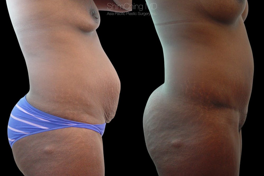 Tummy Tuck Before & After Gallery - Patient 38298983 - Image 3
