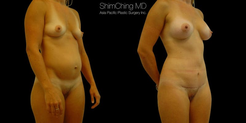 Before and after abdominoplasty in Hawaii with Dr. Shim Ching