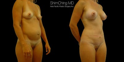 Abdominoplasty Gallery - Patient 38298986 - Image 1
