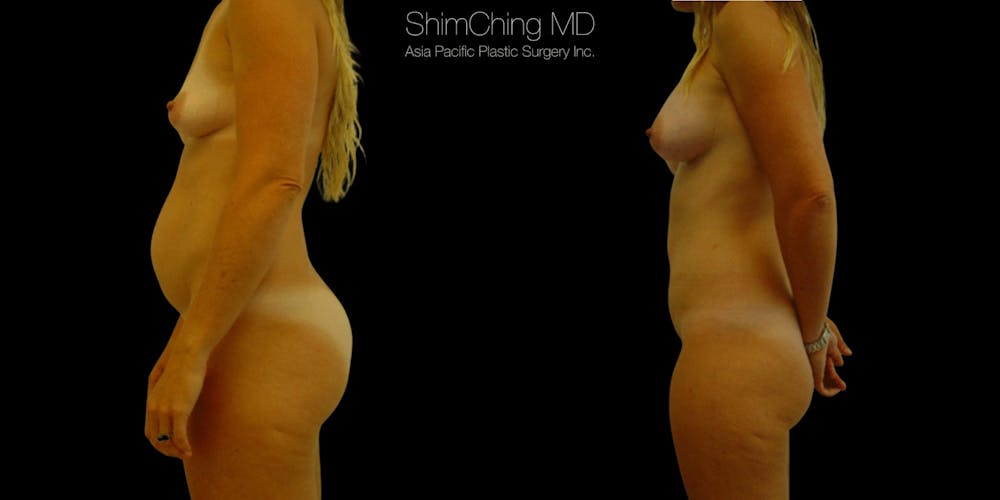 Tummy Tuck Before & After Gallery - Patient 346425 - Image 2