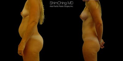 Tummy Tuck Before & After Gallery - Patient 38298986 - Image 2