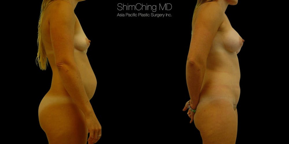 Tummy Tuck Before & After Gallery - Patient 38298986 - Image 3