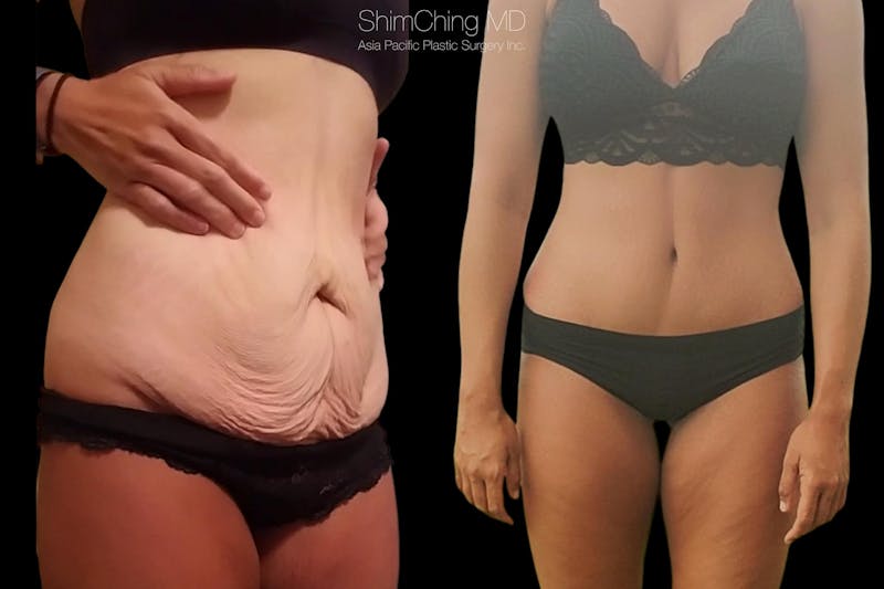 Before and after abdominoplasty in Honolulu with Dr. Shim Ching