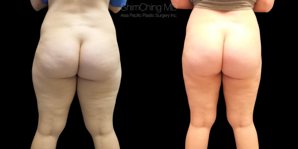 Laser Liposuction Before & After Gallery - Patient 38298989 - Image 1