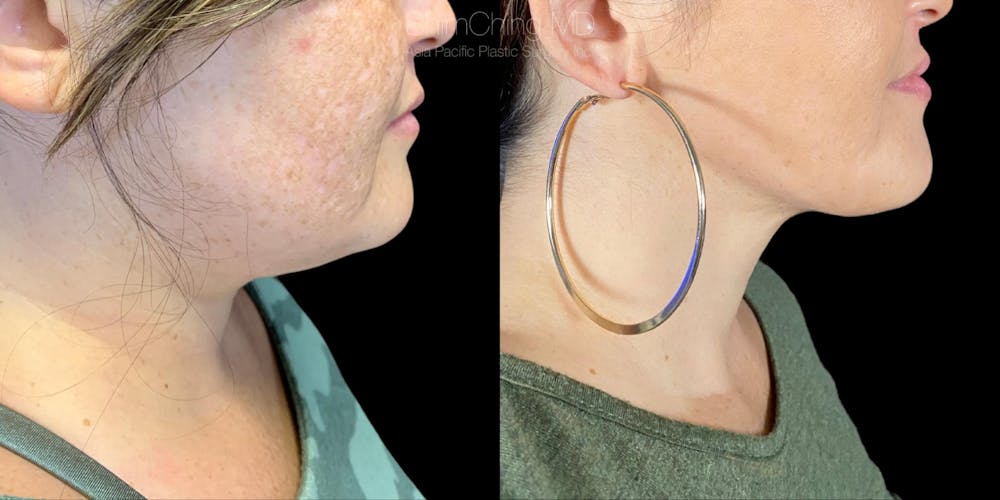 Laser Liposuction Before & After Gallery - Patient 38298994 - Image 1