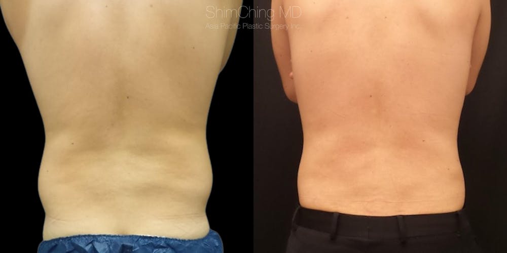 Laser Liposuction Before & After Gallery - Patient 38298995 - Image 1