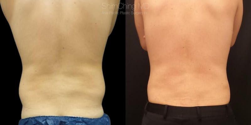 Laser Liposuction