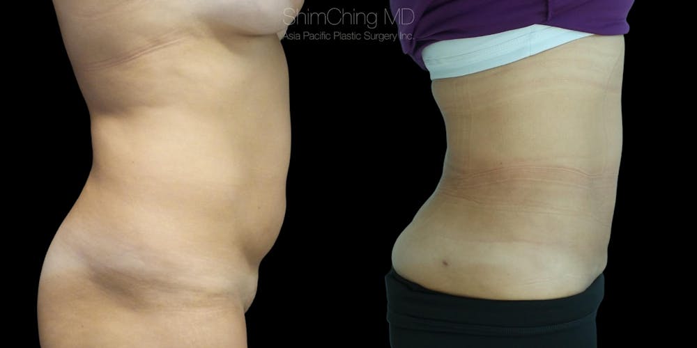 Laser Liposuction Before & After Gallery - Patient 38298997 - Image 1
