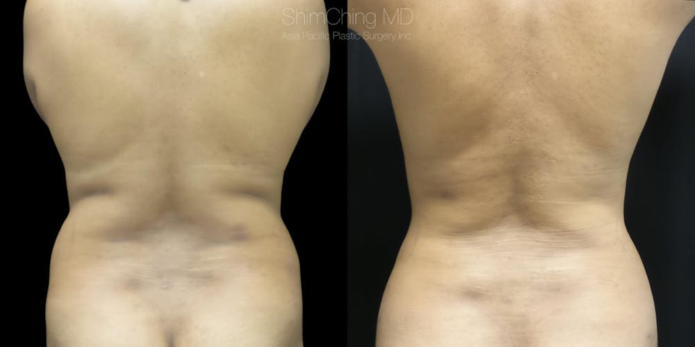 Laser Liposuction Before & After Gallery - Patient 38298998 - Image 1