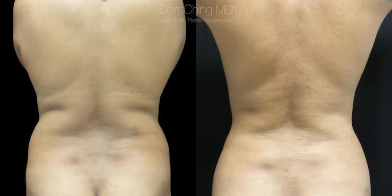 Laser Liposuction