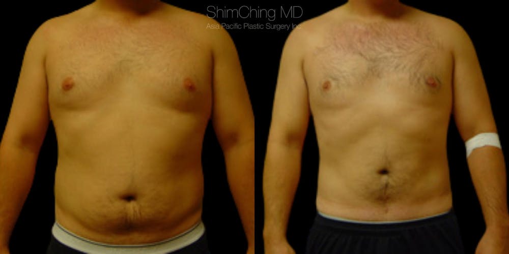 Laser Liposuction Before & After Gallery - Patient 38298999 - Image 1