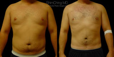 Laser Liposuction Before & After Gallery - Patient 38298999 - Image 1