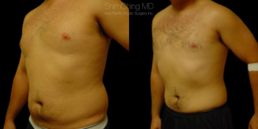 Laser Liposuction Before & After Gallery - Patient 38298999 - Image 2