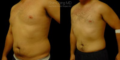 Laser Liposuction Before & After Gallery - Patient 38298999 - Image 2