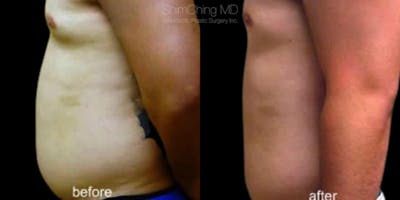 Laser Liposuction Before & After Gallery - Patient 38299000 - Image 1