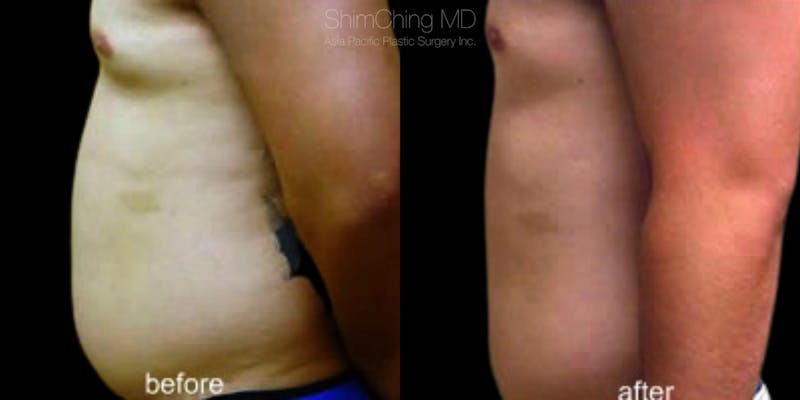 Laser Liposuction