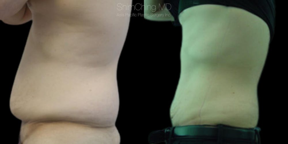 Laser Liposuction Before & After Gallery - Patient 38299001 - Image 1