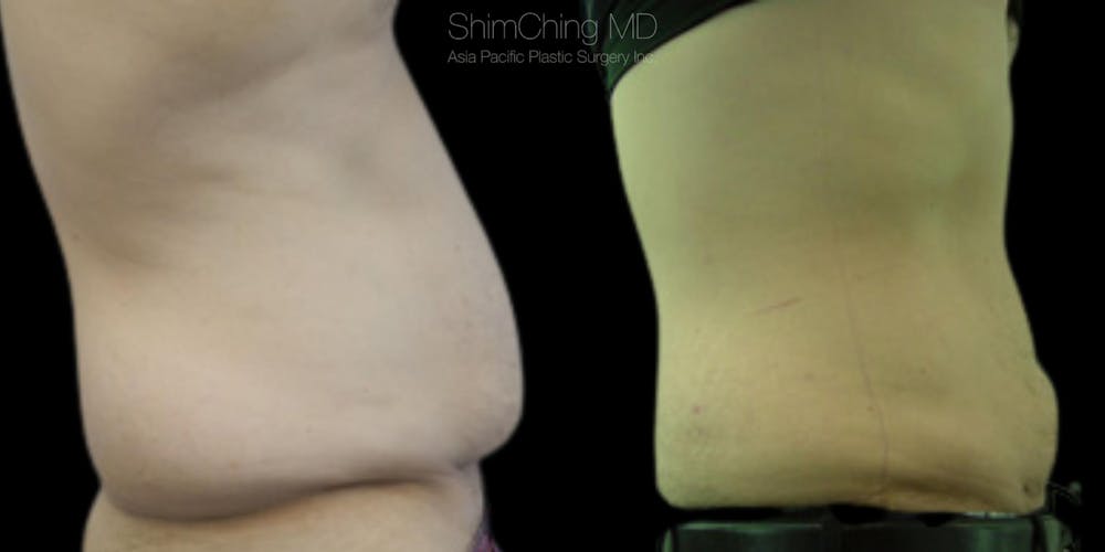 Laser Liposuction Before & After Gallery - Patient 38299001 - Image 2