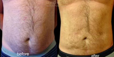 Laser Liposuction Before & After Gallery - Patient 38299002 - Image 1