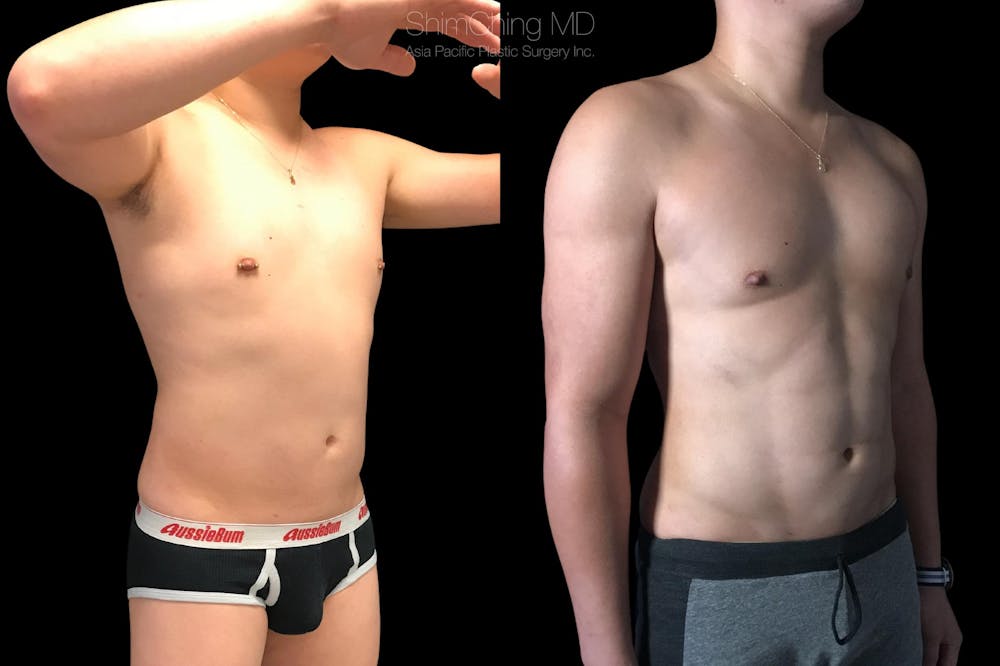 HiDefinition Liposuction Before & After Gallery - Patient 38299008 - Image 1