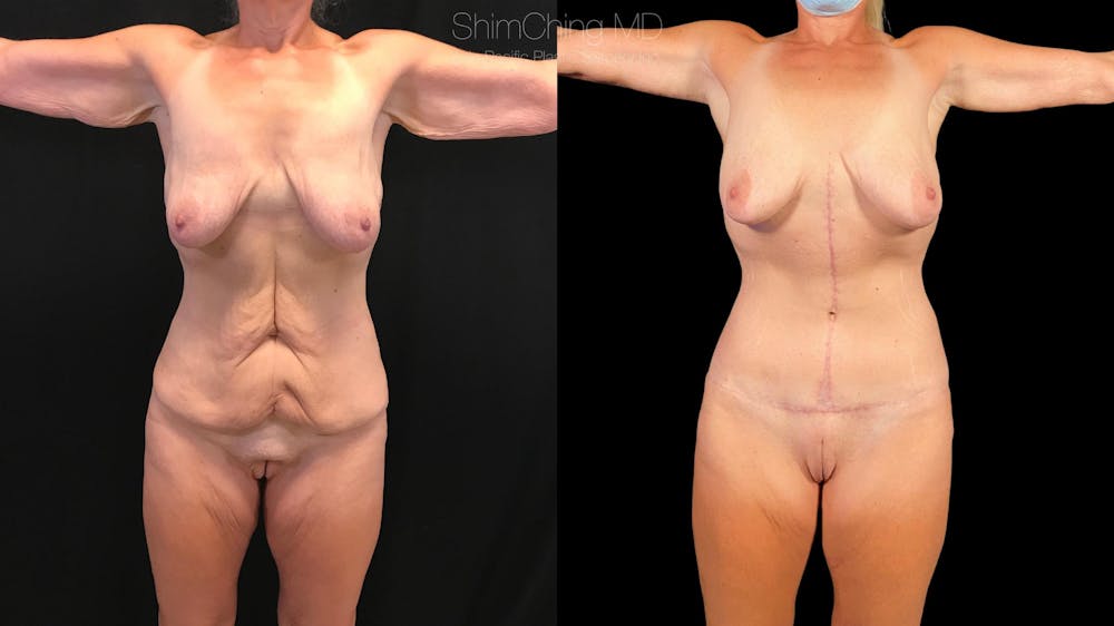 Post-Bariatric Body Contouring Before & After Gallery - Patient 38299009 - Image 1