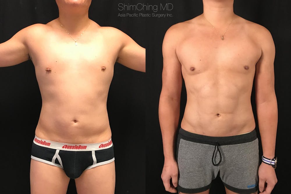 HiDefinition Liposuction Before & After Gallery - Patient 38299008 - Image 3