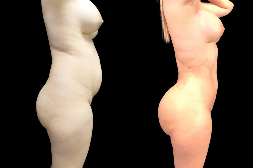 HiDefinition Liposuction Before & After Gallery - Patient 38299012 - Image 1
