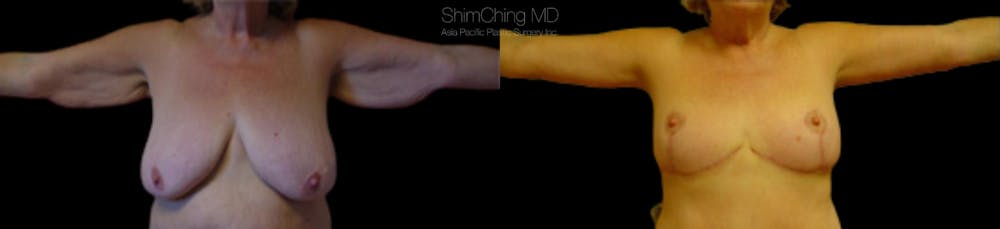 Post-Bariatric Body Contouring Before & After Gallery - Patient 38299011 - Image 2