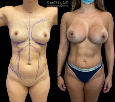 HiDefinition Liposuction Before & After Gallery - Patient 38299019 - Image 1
