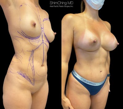 HiDefinition Liposuction Before & After Gallery - Patient 38299019 - Image 2