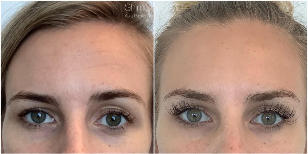 Botox Before & After Gallery - Patient 38307313 - Image 1