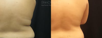 CoolSculpting Before & After Gallery - Patient 38307317 - Image 1