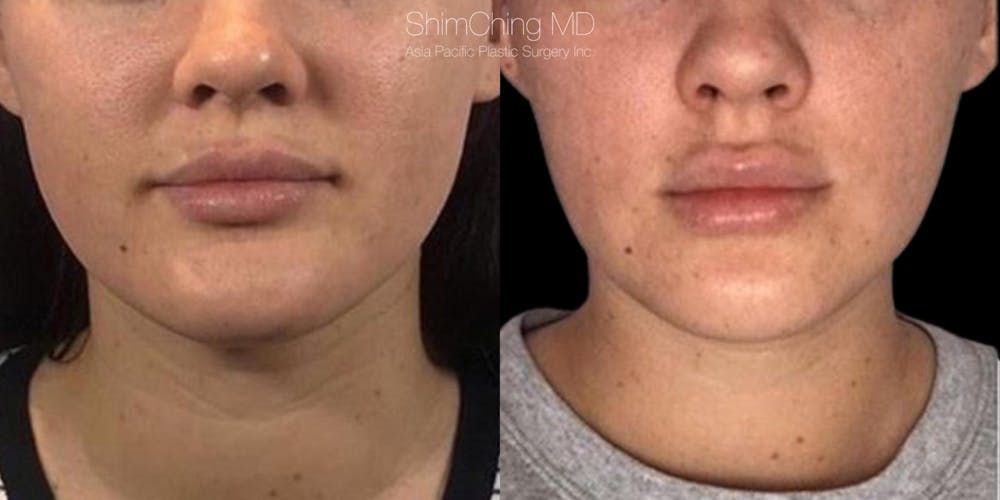 Botox Before & After Gallery - Patient 38307326 - Image 1