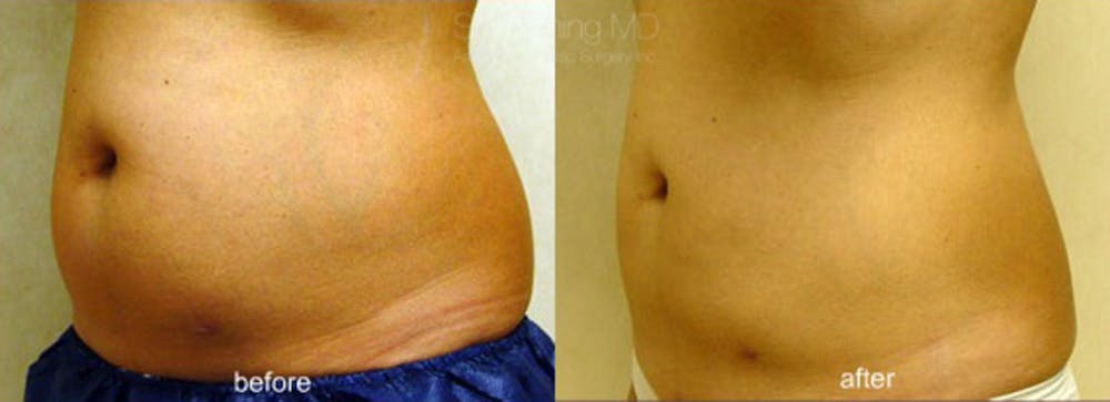 CoolSculpting Before & After Gallery - Patient 38307327 - Image 1