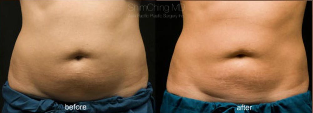 CoolSculpting Before & After Gallery - Patient 38307328 - Image 1