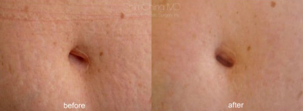 Laser Resurfacing Before & After Gallery - Patient 38307330 - Image 1