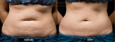 CoolSculpting Before & After Gallery - Patient 38307331 - Image 1