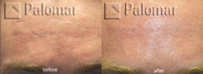 Laser Resurfacing Before & After Gallery - Patient 38307332 - Image 1