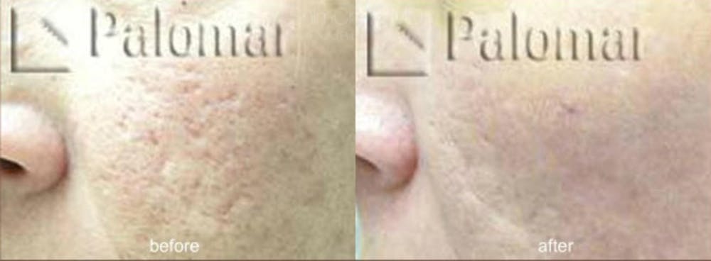 Laser Resurfacing Before & After Gallery - Patient 38307336 - Image 1