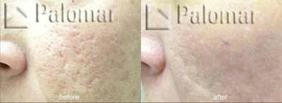 Laser Resurfacing Before & After Gallery - Patient 38307336 - Image 1