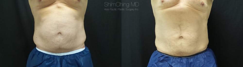 CoolSculpting Before & After Gallery - Patient 38307338 - Image 1