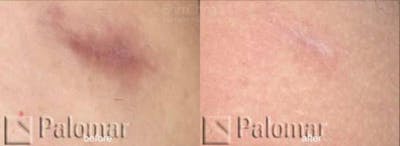 Laser Resurfacing Before & After Gallery - Patient 38307337 - Image 1