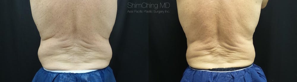 CoolSculpting Before & After Gallery - Patient 38307338 - Image 2