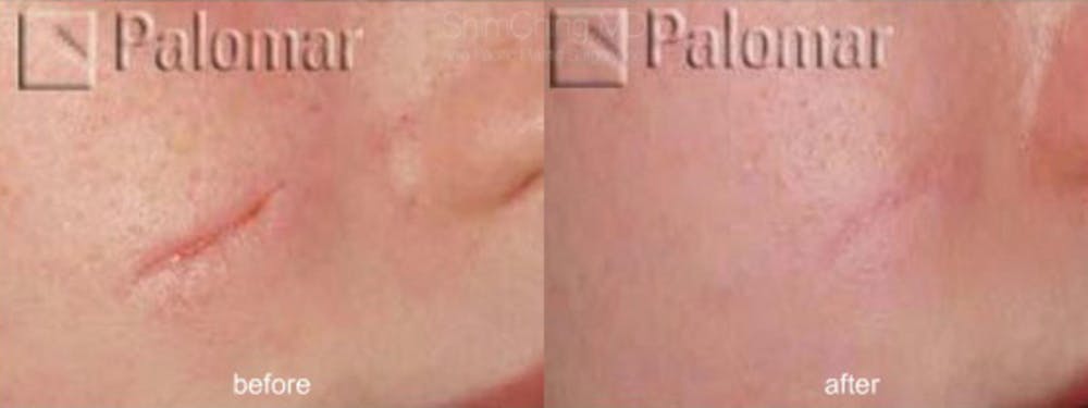 Laser Resurfacing Before & After Gallery - Patient 38307340 - Image 1