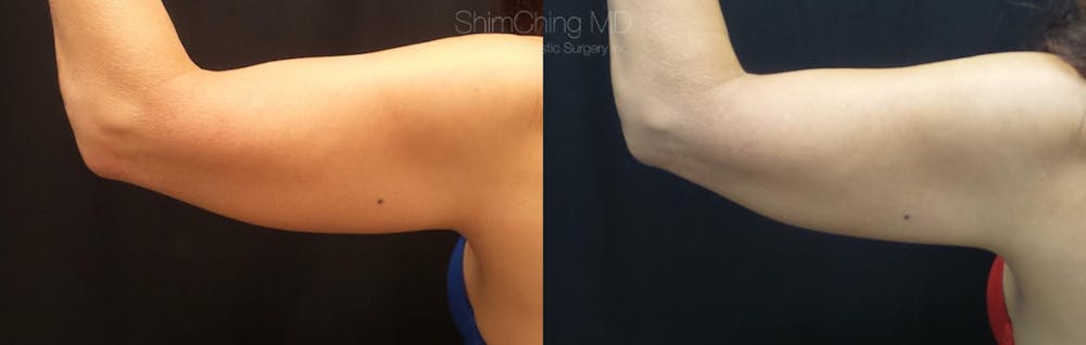 CoolSculpting Before & After Gallery - Patient 38307341 - Image 1