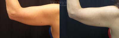 CoolSculpting Before & After Gallery - Patient 38307341 - Image 1