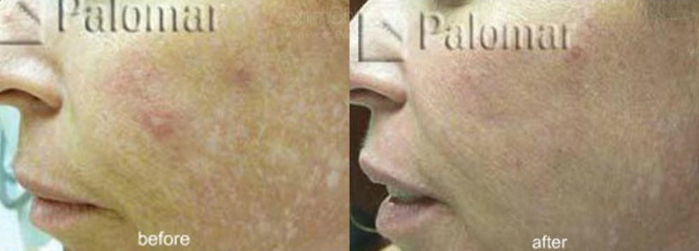 Laser Resurfacing Before & After Gallery - Patient 38307344 - Image 1